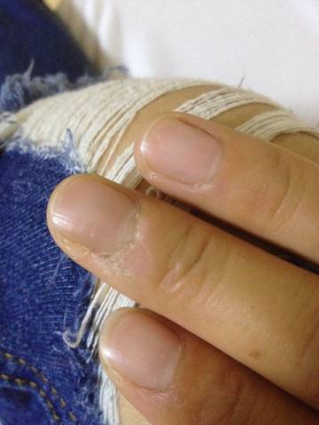 图片太恶心被删了吗,好吧,那我换个图_趾疣,趾