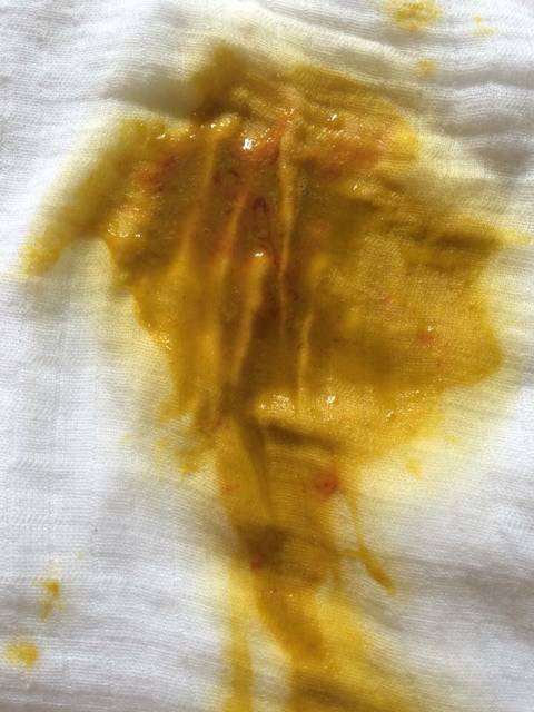 五个月宝大便有血,有图,希望知道的宝妈能够帮