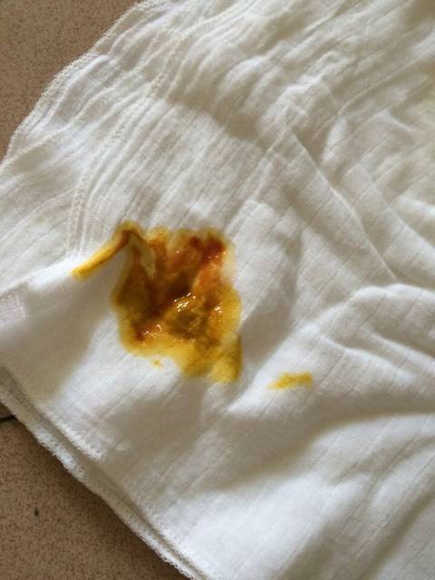 五个月宝大便有血,有图,希望知道的宝妈能够帮