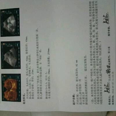 怀孕33周了,医生说我羊水多,我上网查了一下说