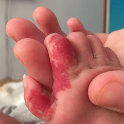 宝宝才27天,手上有一块红斑记,不知道是不是血管瘤