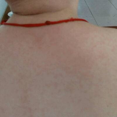 请问这是热痱子吗?