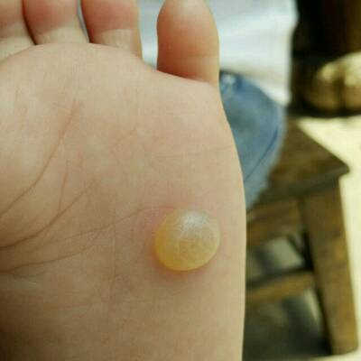 我家宝宝脚底长了一个水泡,这个影响打预防针
