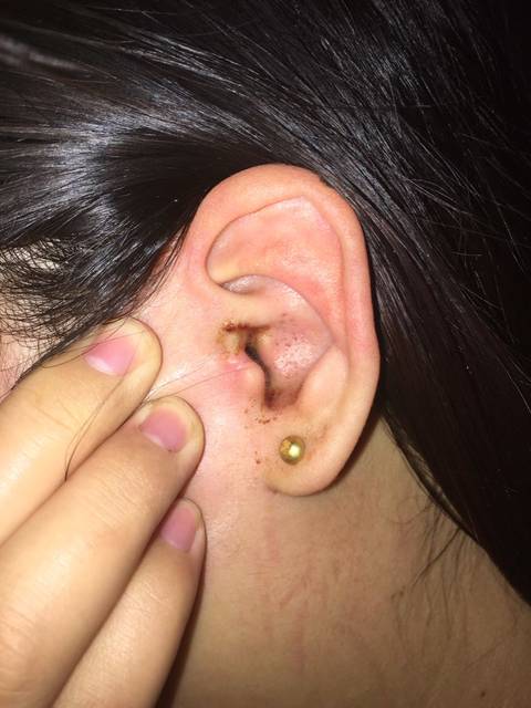 【专家在线】产后如何进行盆底肌修复