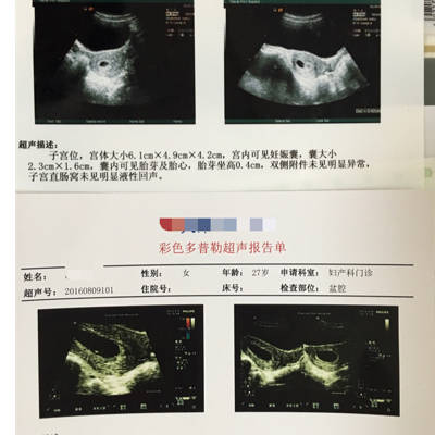 7+周时候胎芽胎心都有,11周了胎心没了。一点妊娠反应都没有。是不是肯定要人流了?_育儿问答_宝宝树