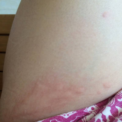 我现在怀孕3个月,今天中午突然手臂上痒,挠了
