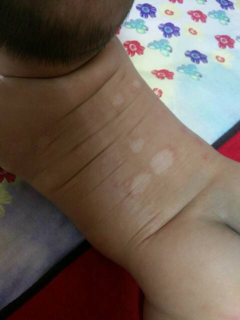 到底是湿疹还是真菌感染,一个医生一种说法_各