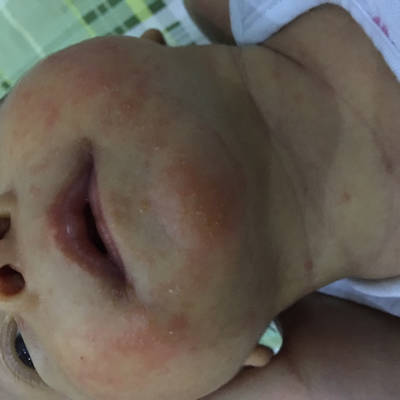 宝宝今天29天脸上起的这个红色的疹子,刚开始