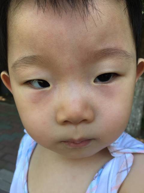 一岁宝宝 眼睛像是有黑眼圈 有经验的帮忙看看