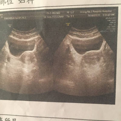 我做了b超可是我当时不懂 就没问我是子宫前位还是后位!