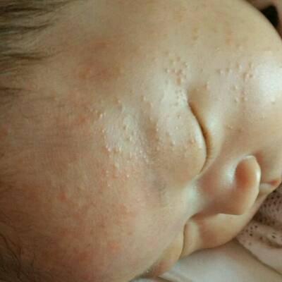 宝宝还没满月,脸上都是一粒一粒的,这是湿疹吗