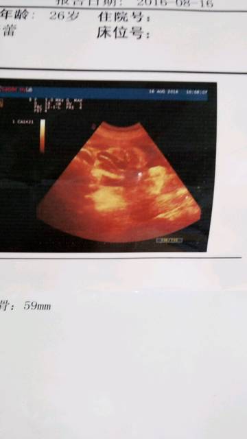 孕35周了_怀孕八个多月了,半个月前做B超查胎