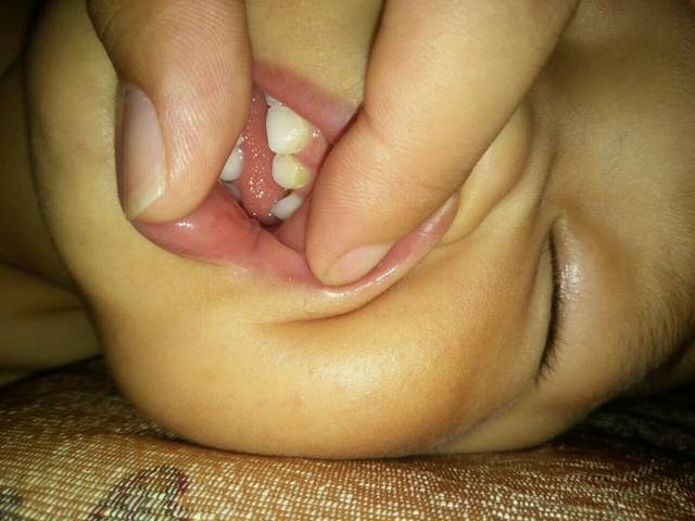 一岁七个月的宝宝牙齿黄怎么回事,大牙发黑了