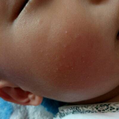 宝宝脸上起了白色米粒小疙瘩胳膊上也有好几个
