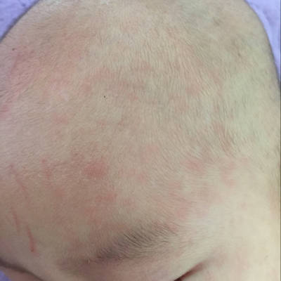 宝宝五个月了前两天有点发烧从昨天开始脸上有