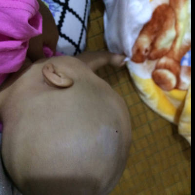 五个月宝宝头上有白斑是白癜风的初期症状呢