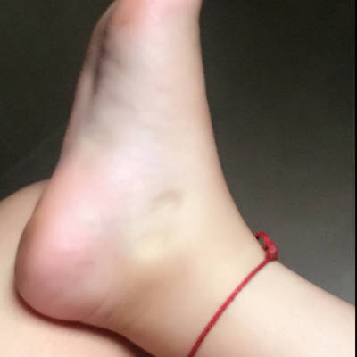 肿成这个样子,一按一个坑,半天消不了.怎麼缓解缓解啊?