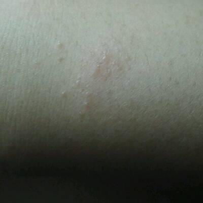 身上好多地方起了一堆一堆的小水苞,大部分不