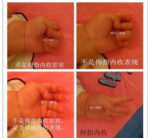宝宝七个月了,拇指内扣,有时内扣,会拿东西,有没有同样的宝宝?