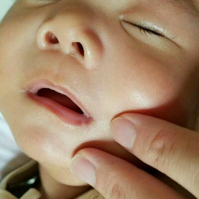 宝宝两个月,发现嘴唇左边有个小白斑,不知什么