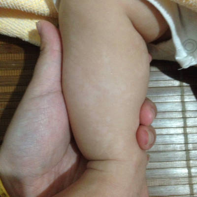 两个月宝宝小腿出现白色斑块,怎么回事啊?
