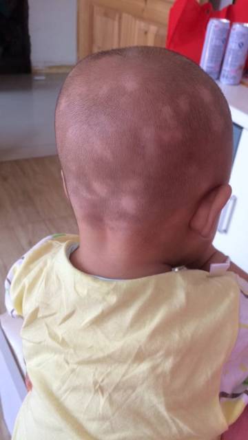 新人报到_我宝宝三个多月了头上长了好多白色