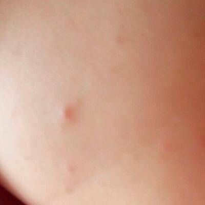 这是水痘吗?_宝宝树