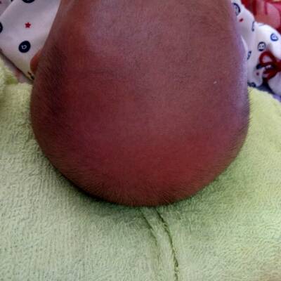宝宝一个月零六天了 前面的头发比后面的少 怎