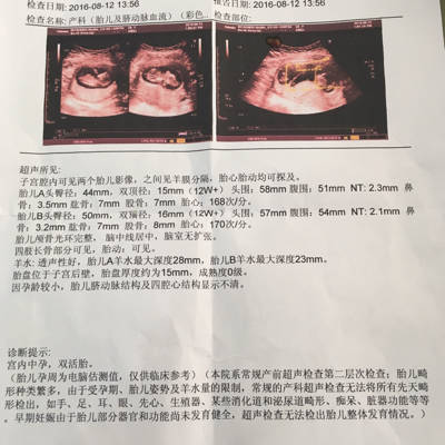 请问是单卵双胎还是双卵双胎?_育儿问答_宝宝树