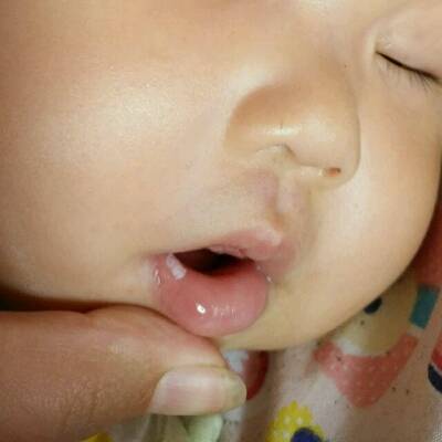六个月的宝宝嘴巴里面长了雪花状的白色是怎么