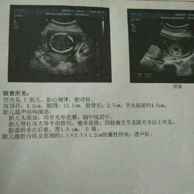 怀孕20周,产检时检查出胎儿腹腔内有囊肿(脊柱
