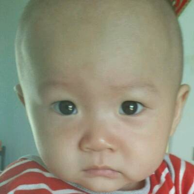 宝宝今天早上起床后突然脸颊眉毛鼻子那一块红