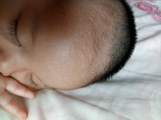 50多天的宝宝最近发现右侧额头太阳穴部位长