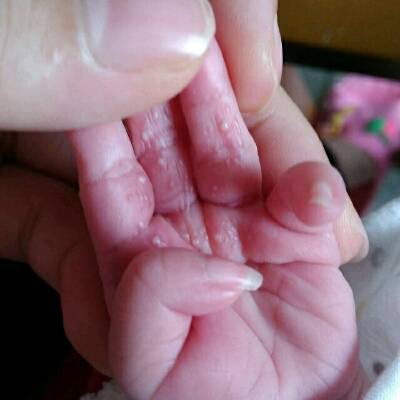 我的宝宝出生两个星期了,手掌的地方长水泡一