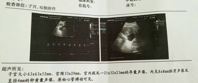 第一次检查_孕50天,第一次去做B超,宫内胎心胎