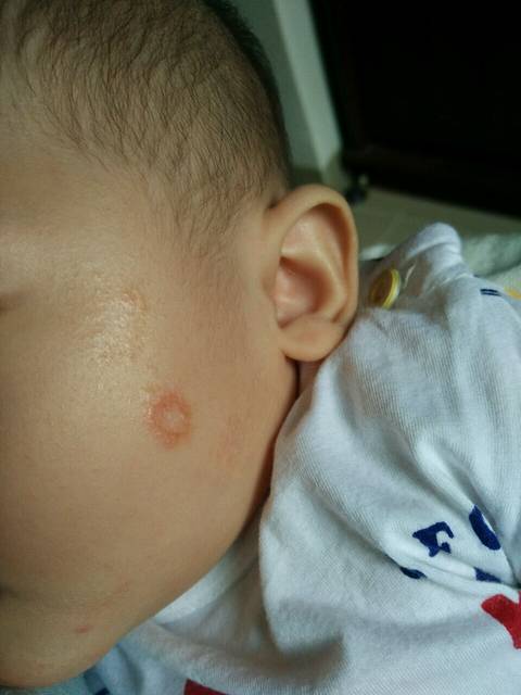 宝宝脸上长了个红印。如图