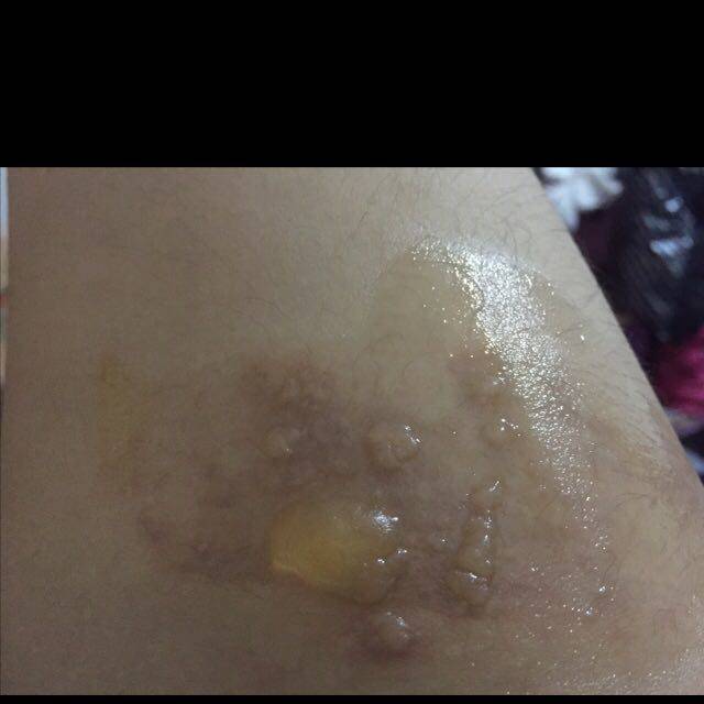 怀孕中期不小心被开水烫了_怀孕中期不小心被