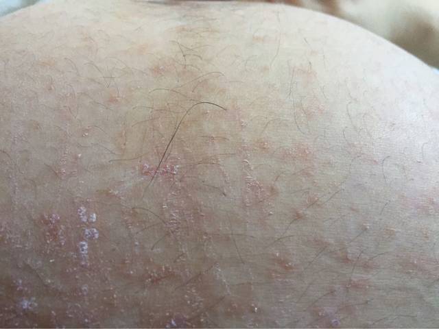 身上长痘了_我怀孕七个月了,身上痘痘长了快两