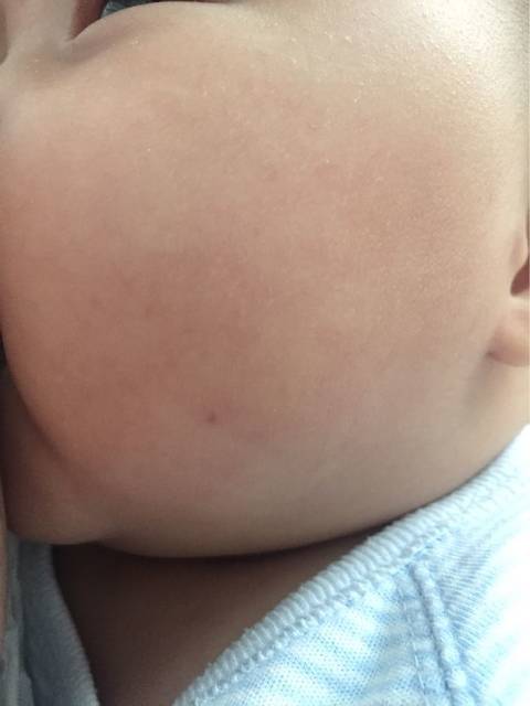 这是血管痣吗?_宝宝现在三个月,脸上突然长了