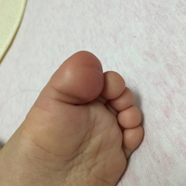 宝宝脚大拇指下面长了一个包_宝宝脚大拇指下