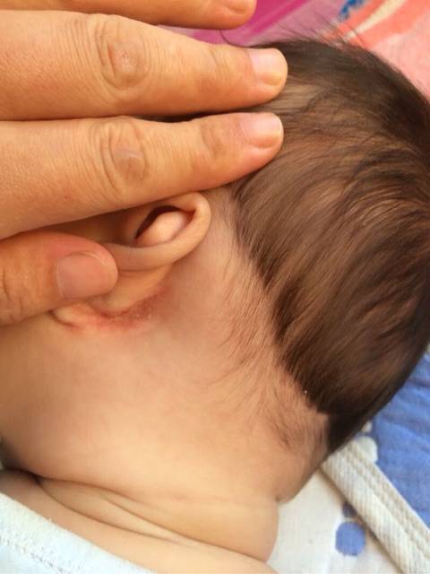 宝宝耳朵后面是发炎吗_应该怎么消除呢