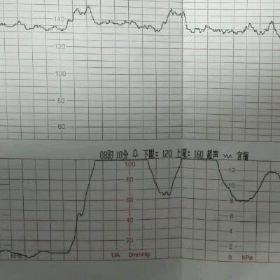 36周,胎心监护,宝宝胎心在120到160间,但宫缩不规律,且吸氧半小时后