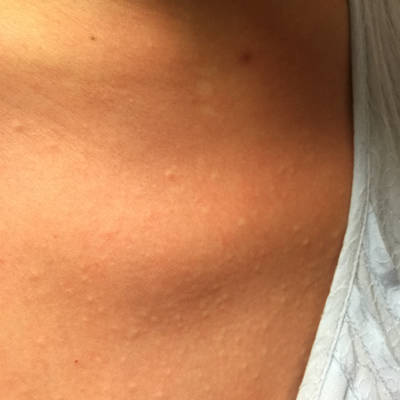 怀孕22周+1天,这几天身上起了好多红点,特别痒