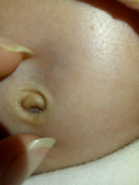 帮忙看看宝宝肚脐眼正常吗?一个月了,还流黄色