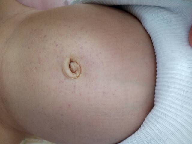 肚脐周围的小点点_宝宝两个月了 最近肚脐周围