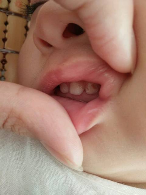宝宝牙齿坏了怎么办?_我家宝宝一岁四个月了