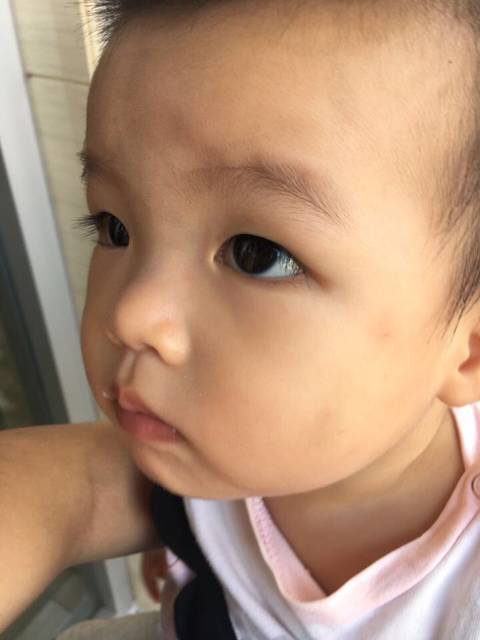 宝宝的侧脸在阳光下看起来有白斑是怎么回事?