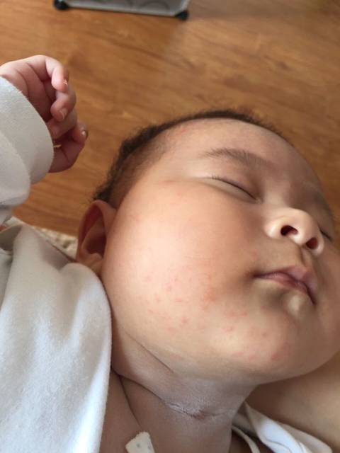 宝宝下巴一圈长了好多小疙瘩,是湿疹还是什么