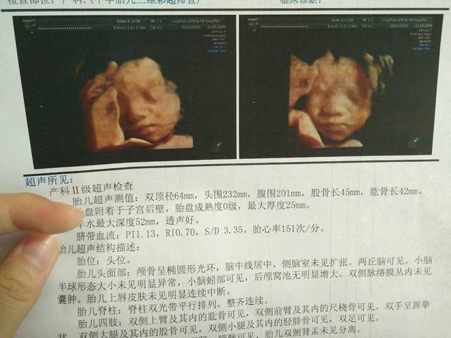四维彩超通过,孩子的大鼻子丑萌丑萌哒