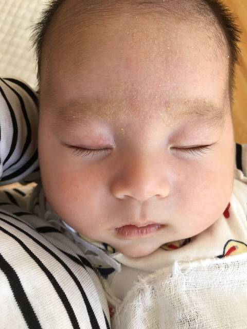 宝宝眼皮上有红血丝是怎么回事_宝宝眼皮上有